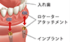 画像：ロケーターインプラント義歯